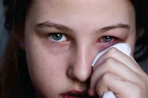 Var ise serum fizyoloji ile yok ise su ile bol ykayarak gz hekimine bavurunuz.