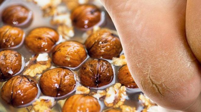 Doal yntemlerle cilt sorunlarna zm arayanlarn vazgeilmezi haline gelen ceviz suyu, zellikle atlaklar ve nasrlarn yumuatlmasnda faydal etkiler sunuyor. te halk arasnda giderek poplerleen bu yntemin tm detaylar.