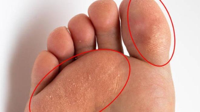 Ceviz, doann bize sunduu en ifal besinlerden biri. Sadece i ksm deil, kabuu bile bal bana bir salk kayna. Ceviz suyunun ierisindeki vitaminler mineraller ve doal yalar cildi yumuatarak atlak ve nasr gibi sorunlar zmede etkili olur.