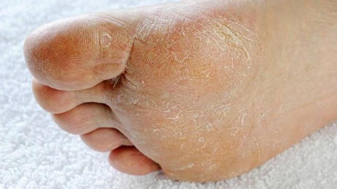 Ceviz suyunu bu kadar etkili yapan ey, doal olmasndan kaynaklanr. atlaklar ve nasrlar gibi sorunlar iin kimyasal ierikli rnlere ynelmek yerine, ceviz suyunun iyiletirici gcnden faydalanabilirsiniz.