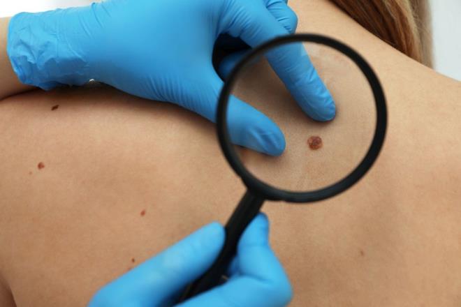 Cilt kanserinin en ciddi tr olan melanom, cilde rengini veren melanosit hcrelerinin kontrolsz bir ekilde oalmas sonucu grlr. Dnya genelinde ylda yaklak 160 bin melanom vakas grlmektedir. Nadir grlen bu kanser tr, tedavi edilmediinde tm vcuda yaylabilir. Bu nedenle hastaln erken tehisi byk nem tar.