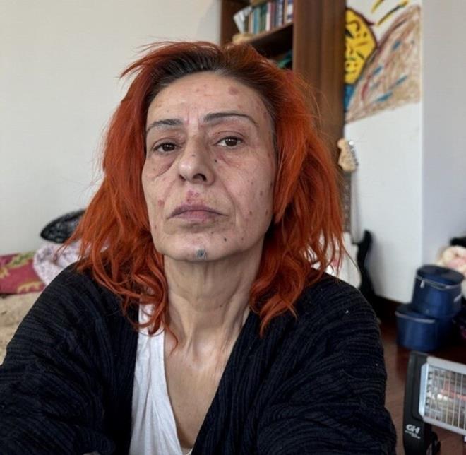 Giyim tarz, kendine has tavrlar ve aklamalaryla gndemden dmeyen Yldz Tilbe, san boyadktan sonra talihsiz bir olay yaad. Yznde yanklar oluan arkc, son halini sosyal medya hesabndan paylamt.    "BR DAHA SAIMA BOYA SRMEYECEM"    nl arkc yzndeki yanklarn net bir ekilde grnd fotoraflarn takipileriyle paylaarak "Bir daha sama boya srmeyeceim. Kimyasal yank oldum" ifadelerini kullanmt.Takipilerinin "gemi olsun" mesajlarna da yant veren 58 yandaki Tilbe, "Doktora gittim, krem-hap verdii her eyi uyguluyorum. Geer inallah, ok sa olsun" demiti.