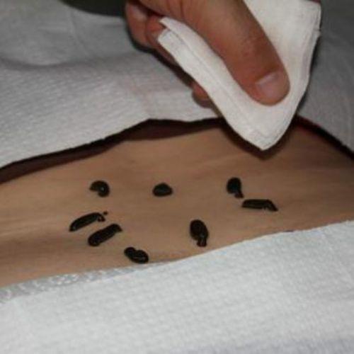 <p><b>TIBB SLKLER</b></p>   Ortaa'da kullanlan bir dier tbbi yntem slklerdi. Kan almaya benzer olarak, slkler zamane doktorlarnn birok hastala neden olduunu dndkleri kirli kan ekmek iin kullanlyordu. Modern tpta, slklere rekonstraktif cerrahide kan akn hzlandrmak iin bavuruluyor. Bu yntem, rnein geri dikilen bir parmakta kan akn artrmakta kullanlyor.