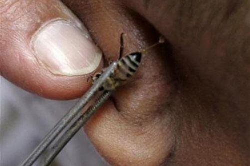 <p><b>ARI TEDAVS</b></p> Bu tedavi gerekten belki de en garip yntemlerden biri; ama, in'de birok doktor tarafndan uygulanyor. Ar inesinde bulunan zehrin romatizma gibi hastalklara iyi geldii dnlyor. Ve sorunlu blgeye ar inesi ile uygulanyor.