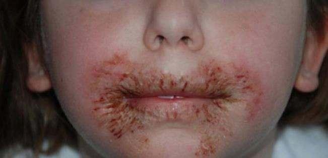 Yaplan alerji testinden sonra, slak mendil kullanmn braknca kk kzn yaralar kayboldu.