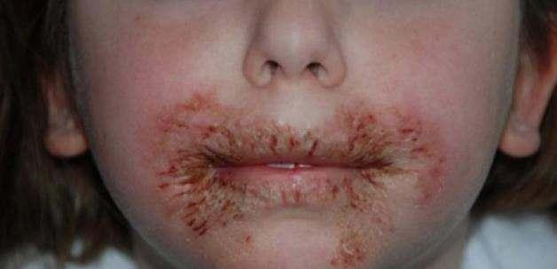 Chang, ayn reaksiyonu birden fazla ocukta grnce bu konuyu detaylca aratrmaya koyuldu Chang, 2 yl sren aratrma sresince slak mendillerde kullanlan maddeleri ve bunlarn zararlarn aratrmaya balad. Chang, slak mendillerin iinde, cilde zarar veren methylisothiazolinone (bebek mendilleri, el kremleri ve losyonlarda sklkla bulunan bir kimyasal madde) maddesine rastlad.