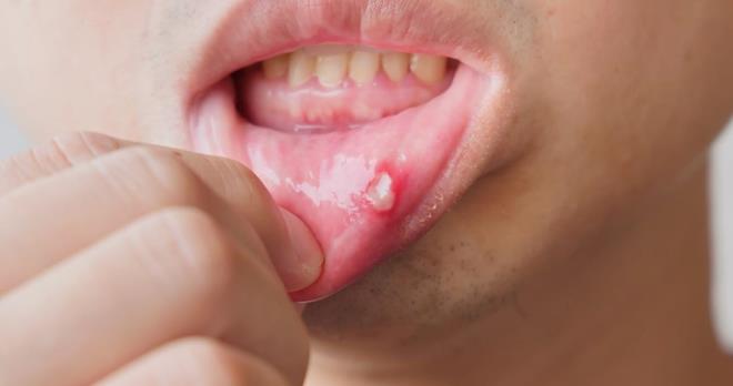 Az kanseri belirtilerinin arasnda, iki hafta iinde gemeyen lserler, azda krmz veya beyaz lekeler, dudaklarda veya azda yumrular ve yutma zorluu yer alyor.    Tappenden-Rowell?in tedavisi, kanserli blgenin dilinden karlmas ve yerine kolundan alnan deri parasnn yerletirilmesiyle gerekletirildi. "Kolumdan alnan deri paras, damarlar ve atardamarla birlikte dilime yerletirildi. Ameliyat sonras youn bakmda uyandmda, dilime alabilmem iin sadece yumuak gdalarla beslenmem gerektiini rendim," diyen Tappenden-Rowell, bir yl sonra hala ikolata gibi baz gdalar tketmekte zorlandn belirtti.