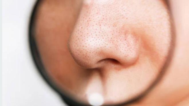 Yumurta ak maskesi, Kore cilt bakmnda siyah noktalar temizlemek ve cildi sklatrmak iin ska kullanlan bir yntemdir. Yumurta ak, cildi geici olarak sklatrr ve gzeneklerde biriken kir ve ya ekmeye yardmc olur. Uygulamak iin bir yumurta akn rpn ve temizlenmi cildinize ince bir tabaka halinde srn. zerine ince bir kt peete yerletirin ve peetenin zerine bir kat daha yumurta ak uygulayn. Tamamen kuruduunda peeteyi nazike soyun.