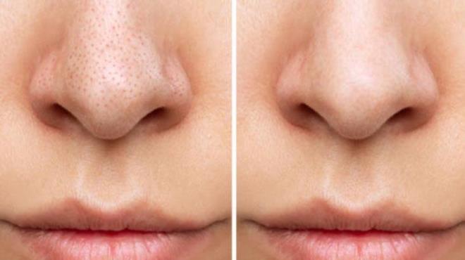 Pirin suyu, Korelilerin geleneksel gzellik srlarndan biridir ve siyah nokta oluumunu azaltmada etkili bir tonik olarak kullanlr. Bir su barda pirinci iyice ykayn, zerine temiz su ekleyin ve 30 dakika bekletin. Bu sre sonunda stte kalan bulank suyu bir kaba aln. Doal toniiniz hazr olacak. Pirin suyu tonerini bir pamuk yardmyla yznze nazike uygulayn. Bu ilem, cildinizi temizlerken ayn zamanda gzeneklerin sklamasn salar ve siyah nokta oluumunu nlemeye yardmc olur.