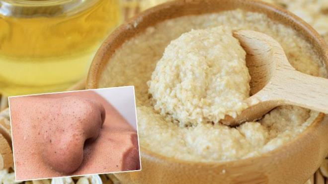 Gney Kore, cilt bakmnda dnya apnda bir ne sahip. zellikle przsz, salkl bir cilt elde etme konusundaki yaklamlaryla dikkat ekiyor. Koreliler, bu siyah nokta problemini zmek iin hem evde uygulanabilecek pratik yntemler hem de doal rnler kullanmay tercih ediyor. te siyah noktann izini bile brakmayan tarifler.