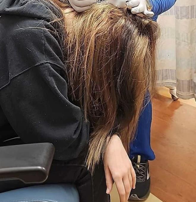 Doktorlar, niversite rencisinin vcudunda portakal byklnde l deri ukuru amak zorunda kald ve bunun sonucunda Martin?in sa kmayacak bir blge olutu. Martin, ?Olaydan bu yana tek bir sa kk bile kmad. Bir daha orada sam olmayabilir? ifadelerini kulland.    Kimyasal yann, sa boyasnda bulunan ve cildi tahri eden hidrojen peroksit veya amonyak gibi maddelerden kaynaklanm olabilecei belirtiliyor.