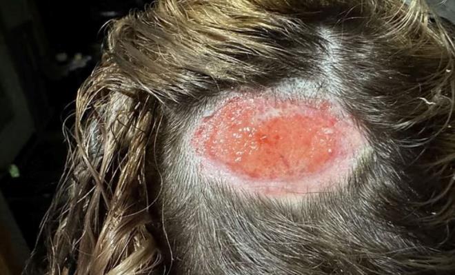 Evine dndnde ise banda uzun, krmz bir izgi belirdi ve ksa sre sonra kafa derisinden deri ve sa paralar dkld. Hastaneye kaldrlan gen, doktorlar tarafndan epidermis ad verilen cildin en d tabakasnda birinci derece kimyasal yank geirdii bildirildi.