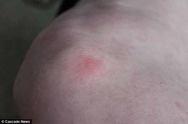 �ngiltere'de kara dul �r�mce�i taraf�ndan �s�r�lan bir adam�n aya�� neredeyse kesilecekti. Doktorlar�n uzun s�reli m�dahalesi sonucu adam�n aya�� kurtar�ld�.