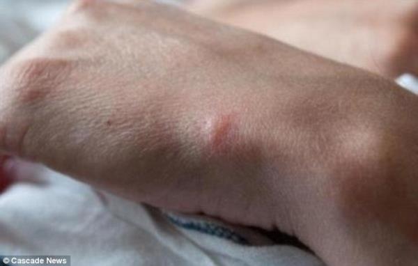 �ngiltere'de kara dul �r�mce�i taraf�ndan �s�r�lan bir adam�n aya�� neredeyse kesilecekti. Doktorlar�n uzun s�reli m�dahalesi sonucu adam�n aya�� kurtar�ld�.