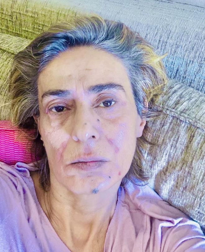 <h2 class="womanpage-gallery-detail-sub-title womanpage-gallery-detail-card-frame--sub-title">YORUM YADI</h2>              <p class="card-text gallery-page-hero-card-text"></p><p>X hesabndan bir fotoraf yaynlayan Tilbe'nin yzndeki yara izleri dikkat ekti.</p>  <p>nl sanatya, hayranlarndan "Cildinize ne oldu?", "Yznzde yine yaralar km", "Ne oldu abla sana?" gibi yorumlar geldi.</p>