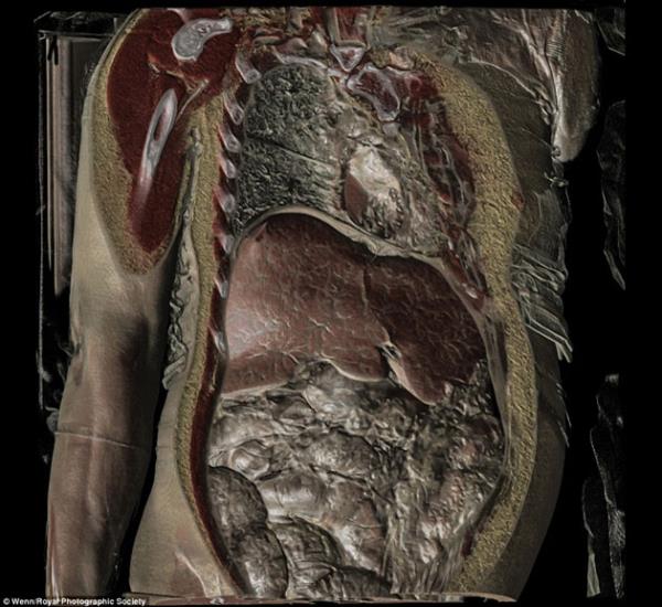 Tbbi grntleme sistemleri insanlarn vcudunu kesikmi gibi grntleyebiliyor..