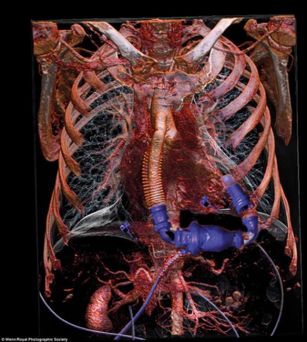 Artk insan vcudunda insan yapm gelimi malzemeler kullanlabiliyor..