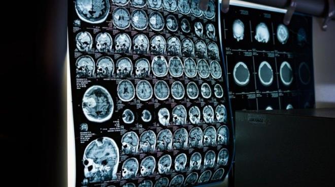 <strong>te yandan Horikawai tekniin beyindeki dil merkezlerinden bamsz altn aklad. Bu da aratrmann afazi veya ALS gibi konuma yetisini etkileyen hastalklarda potansiyel yardm salayabileceine dikkat ekti.</strong>