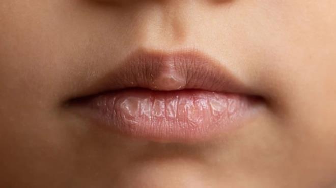 Havalarn soumaya balad k gnlerinde dudaklarmz da kurumaya ve atlamaya daha msait bir hale gelir. Dudaklarda oluan atlamalar hem dudamzn daha cansz grnmesine yol aar hem de atlaklar nedeniyle can yakar. Dudak kremleri herhangi bir ie yaramadysa o halde sizler de doal yntemler ile dudaklarnz nemlendirebilirsiniz. Dudaklarda oluan atlaklardan kurtulmak ve dudaklarnza ihtiya duyduu doal nemi salamak iin tercih edebileceiniz doal yntemler ile dudaklarnz pamuk gibi yumuayabilir. te salk nerileri ierisinde karmza kan doal yntemler: Havalarn soumaya balad k gnlerinde dudaklarmz da kurumaya ve atlamaya daha msait bir hale gelir. Dudaklarda oluan atlamalar hem dudamzn daha cansz grnmesine yol aar hem de atlaklar nedeniyle can yakar. Dudak kremleri herhangi bir ie yaramadysa o halde sizler de doal yntemler ile dudaklarnz nemlendirebilirsiniz. Dudaklarda oluan atlaklardan kurtulmak ve dudaklarnza ihtiya duyduu doal nemi salamak iin tercih edebileceiniz doal yntemler ile dudaklarnz pamuk gibi yumuayabilir. te salk nerileri ierisinde karmza kan doal yntemler: