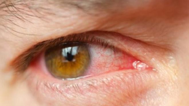 Aile yksnde sar nokta hastal bulunanlarn 50 yandan itibaren dzenli gz muayenesi yaptrmalar gerektiini vurgulayan Yenerel, dzenli takibin, hastaln erken tehis edilmesi ve grme kaybnn nlenmesini sadn vurgulad.