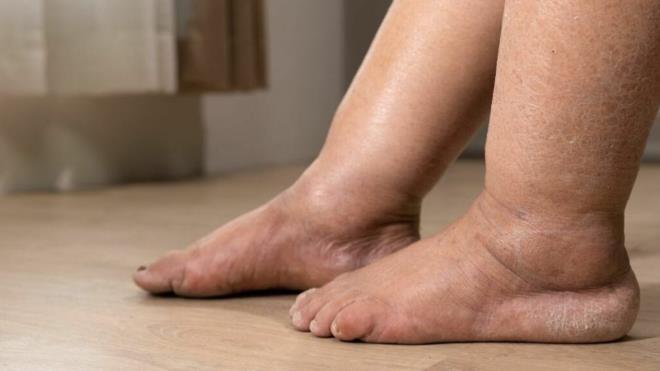 Tuzu Kesin: Kar���m� i�ti�iniz ak�am, yeme�inizdeki tuz oran�n� minimuma indirin. Tuz suyu tutar, bu kar���m ise suyu atar; ikisini sava�t�rmay�n! Y�ksek Yast�k: E�er y�z�n�zde �ok �i�lik oluyorsa, o gece biraz daha y�ksek bir yast�kla yatmak s�v� da��l�m�n� dengeler.