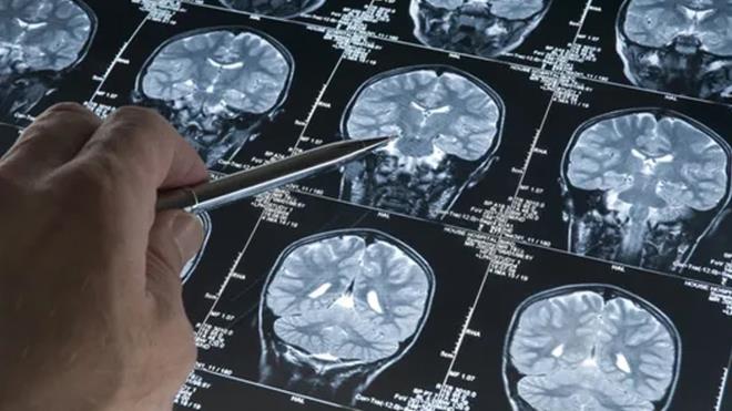 Uzman g�r��lerine g�re brokolinin beyin �zerindeki etkileri yaln�zca tek bir bile�ene ba�l� de�il. Sebzenin iltihap kar��t� ve oksidatif stresi azalt�c� �zellikleri, ya�lanmayla birlikte artan n�rolojik hasara kar�� koruyucu bir kalkan olu�turabiliyor. Bilim insanlar� brokoli, lahana ve karnabahar gibi �arm�ha �i�ekli sebzelerde bulunan do�al bir molek�l�n di� ��r�klerine neden olan bakterileri yok etti�ini a��klad�.