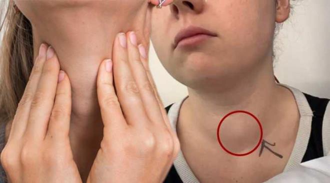 Londra'da ya�ayan 26 ya��ndaki Hannah Sheridan, arkada�lar�n�n fark etti�i boyun �i�li�inin aylar sonra papiller tiroid kanseri oldu�unu ��rendi.