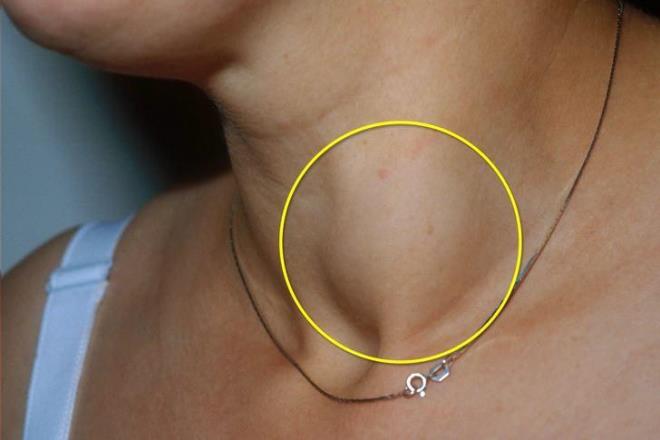 YILLARCA ��KAYETLER� G�RMEZDEN GEL�ND�  <br>    Y�llarca hormon ve mide problemleri ile m�cadele eden Sheridan'a, polikistik over sendromu (PCOS) ve irritabl ba��rsak sendromu (IBS) te�hisi konulmu�tu. Ancak �ikayetleri her ge�en g�n artan 26 ya��ndaki gen� kad�n 2025 y�l�n�n may�s ay�nda boynundaki �i�lik i�in doktora gitti�inde b�y�k bir �okla kar��la�t�.