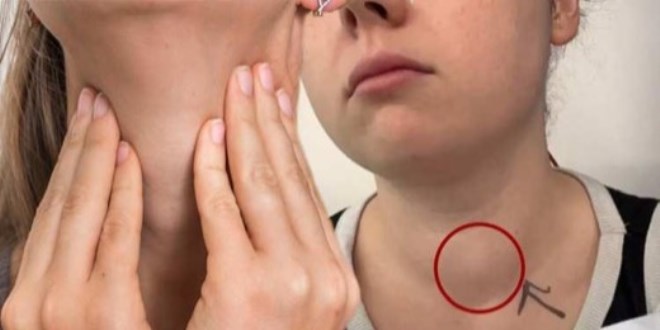 Tiroid kanseri oldu�unu arkada�lar� fark etti