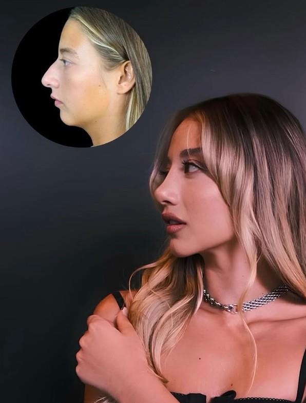 <p><strong>ALEYNA KALAYCIO�LU'NUN ESTET�K GE�M���</strong></p><p>Aleyna Kalayc�o�lu, Survivor sonras� m�zik d�nyas�na ad�m atmadan hemen �nce burun operasyonu ge�irmi�ti. O d�nemde �ark�c� Berkay'�n klibinde oynamak i�in estetik yapt�rd��� iddialar�yla g�ndeme gelen Kalayc�o�lu, bu karar� tamamen kendi iste�iyle ald���n� belirtmi�ti. Doktoru taraf�ndan 25 �ubat 2026 tarihinde payla��lan g�rseller, bu s�recin profesyonel sonu�lar�n� bir kez daha hat�rlatt�.</p>