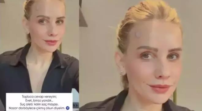 Erol, "Evet, biraz yand�k. Su� aleti; kal�n sa� ma�as�. Nazar da b�yle ��km�� olsun diyelim" diyerek ya�ad��� kazay� esprili bir dille payla�t�.