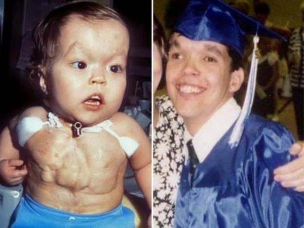 <b>Kalbi gsnde atyor:</b> Christopher Wall doduu gnden itibaren kalbi gs boluunun dnda atyor. Doktorlar kk ocuun yaayacan dahi umut etmezken Wall, 34. doumgnn kutlamay baard.