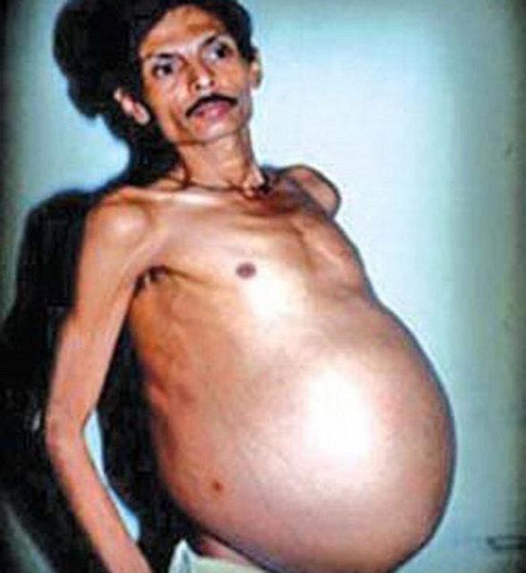 <b>36 yl boyunca gbeinde ikizini tad:</b< Sanju Bhagat'n her zaman dokuz aylk hamile gibi grnen gbei onu rahatsz etse de 1999 ylna kadar baka bir hastalktan hastaneye bavurana kadar ne olduu anlalamad. 36 yanda doktora gittiinde ise ilgin gerekle karlat. Doktorlar bir tmr beklerken ikizinin iinde yaadn renen Bhagat'a yaplan operasyonla kardei iinden alnd