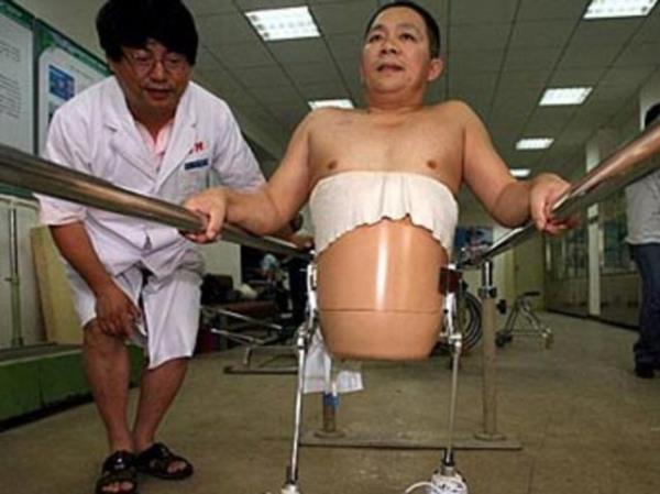 Bacaklar olmayan Shulin yine de yaamay baard ve u an biyonik bacaklar ile vcudunun st ksmn kullanabiliyor.