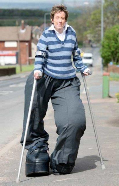 <b>Dev bacakl kadn:</b> Doktorlar Mandy Sellars doduu andan itibaren bir eylerin ters gittiini anlamt. 34 yandaki kadnn bacaklar doduu gnden beri artc bir biimde byyor.