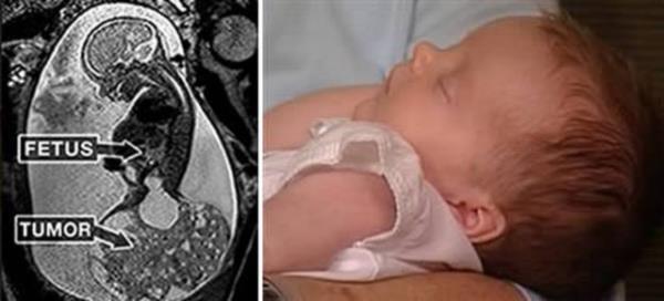 Bunun zerine doktorlar tmr kartmak iin bebein yzde 80'ini anne karnndan kardlar ve tmr aldktan sonra bebei tekrar yerine koydular. 10 hafta sonra kk bebek ikinci defa dnyaya gelmeyi baard.