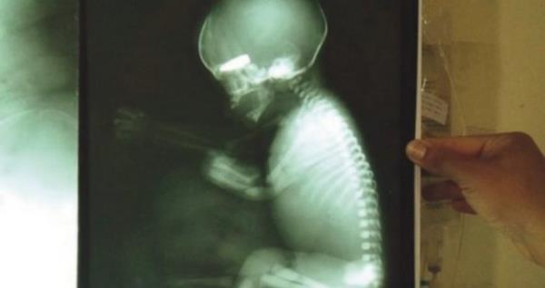 <p><b>KAN DONDURAN DDA</b></p>    Suriye'de be hafta boyunca gnll olarak alm bir doktorun anlattklarna gre Esad ordusunun keskin nianclar, 'sigarasna iddiaya girip' hamile kadnlarn karnndaki bebei kim vuracak yarmas yapyor.