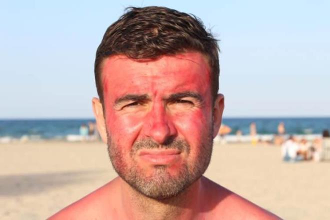 Maruz kal�nan g�ne� ���nlar�n�n k�sa ve uzun vadeli d�nemlerde etkilerini anlatan T�rk Dermatoloji Derne�i Y�netim Kurulu �yesi Dr. Yal��n en s�k g�r�len sorunlar aras�nda g�ne� yan�klar� oldu�unu belirtti.