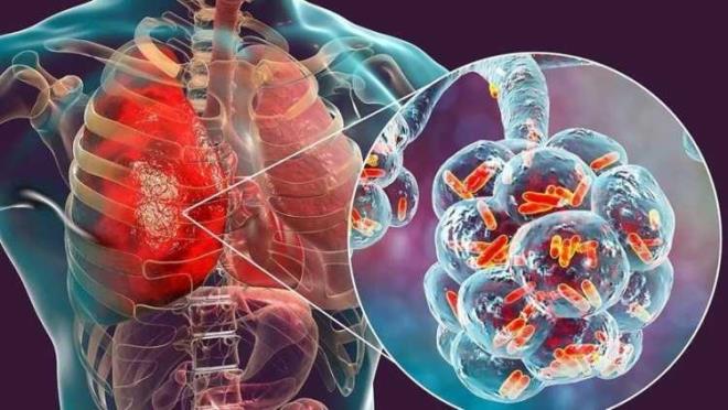 Dr. Akyol, <em><strong>"Legionelle pneumophilia adl� bakteri klimalar�n filtre sistemlerinde uygun nem ve �s�da �o�al�p ortam havas�na da��lmaktad�r. Salg�nlar s�kl�kla otel ve hastanelerde olmakla birlikte, tek tek vakalar da bildirilmi�tir. Klima hastal���n�n insandan insana bula�t��� g�r�lmemi�tir. Akci�erlere giri�i i�in saptanan en �nemli yollar solunum cihazlar�, havaland�rma sistemleri ve hastanelerde solunum yollar�na uygulanan birtak�m i�lemlerdir. Dolay�s�yla, klimalar�n bulundu�u b�y�k otel ve i�yerlerinde �al��an ki�iler ve sa�l�k personeli riskli gruplard�r"</strong></em> dedi.<o:p></o:p>