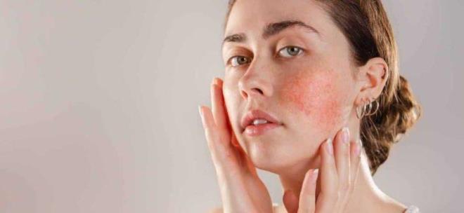Yaz sonunda y�zde artan k�zar�kl�k, yanma ve hassasiyet �ik�yetlerinin kronik bir deri hastal��� olan rozasean�n (g�l hastal���) belirtisi olabilece�ini s�yleyen Dermatoloji Uzman� Dr. G�l �ekerlisoy Tatar, <em><strong>"Tekrarlayan y�z k�zar�kl���, belirginle�en k�lcal damarlar ve yanma hissi ihmal edilmemeli. Erken tan� ve ki�iye �zel tedaviyle hastal�k kontrol alt�na al�nabilir" </strong></em>dedi.