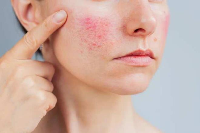 Rozasea tan�s�n�n ekseriy� dermatolojik muayene ile konuldu�unu belirten Uzm. Dr. Tatar, dermoskopi y�ntemiyle ciltteki damar yap�lar�n�n ve Demodex ile ili�kili bulgular�n de�erlendirilebildi�ini s�yledi. Gerekti�inde y�zeysel deri �rneklerinin mikroskop alt�nda incelenerek Demodex yo�unlu�unun ara�t�r�labildi�ini ifade eden Uzm. Dr. Tatar, tedavinin ise hastal���n bask�n bulgular�na g�re planland���n� belirtti.
