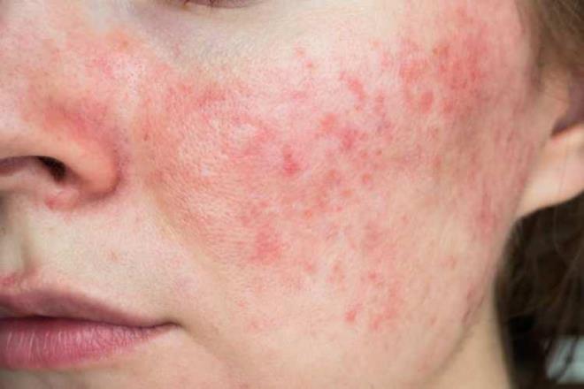<p><strong>G�L HASTALI�ININ �E��TL� TEDAV� Y�NTEMLER� BULUNUYOR</strong></p>    <p>&nbsp;</p>    <p>Demodex yo�unlu�unun artt��� veya iltihapl� kabar�kl�klar�n e�lik etti�i hastalarda uygun topikal ya da sistemik tedavilerin uygulanabildi�ini aktaran Uzm. Dr. Tatar, kal�c� k�zar�kl�k ve belirgin k�lcal damarlar�n �n planda oldu�u hastalarda ise lazer ve ���k temelli uygulamalar�n tedavinin �nemli bir par�as�n� olu�turdu�unu s�yledi.</p>