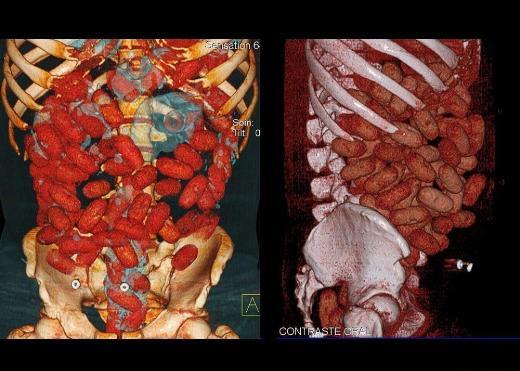 Bu CAT scan grnts ise Brezilya'nn Sao Paulo kentindeki Congonhas Havaliman'nda yakalanan rlandal bir erkee ait. Karn blgesinden alnan bu grntlerde kapsllere doldurulmu 830 gram kokain bulunuyor.