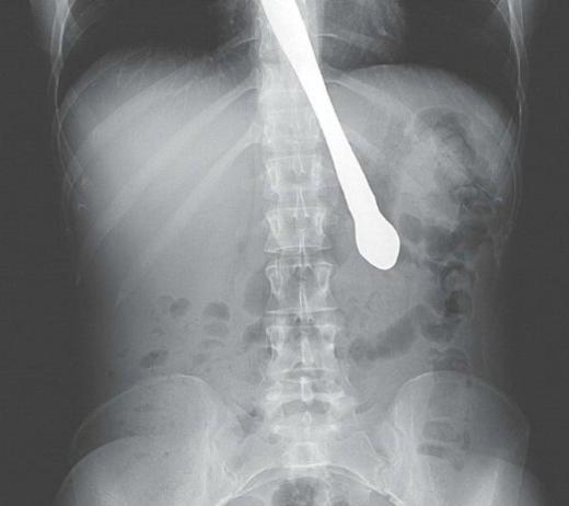 30 yanda Atlanta'da yaayan ve gemiinde bulimia olan bir kadn, artk rme refleksini yendiini kantlamaya alrken yanllkla bak yuttu.