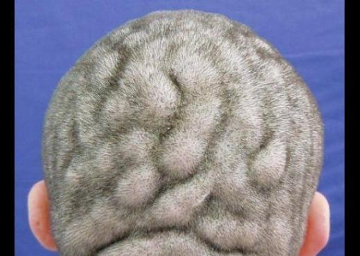 Bunu grntlemek iin medikal bir ynteme ihtiya yoktu. Cutis Verticis Gyrata denilen bu hastalk, kafa derisinin sanki beyin yzeyi gibi grnmesi sonucu oluuyor.