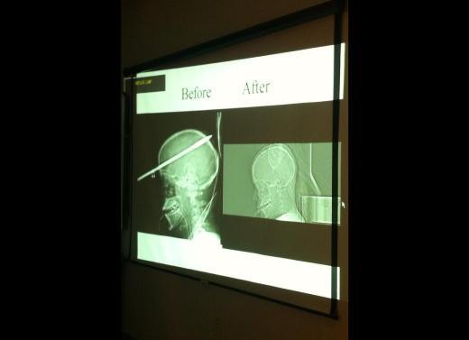 Miami'de yaayan gen bir erkek, klbal avlamak isterken kaza sonucu kendini avlad. Olta takmnn uzun metal paras kafasnn n ksmndan giren gen, ans eseri kurtarlabildi.