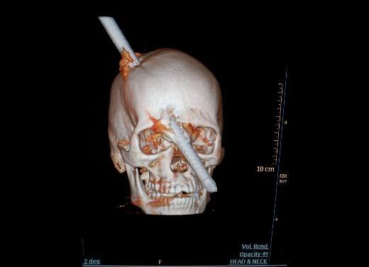 Bu tomografi grnts ise 24 yanda bir inaat iisi olan Eduard Leite'ye ait. Kafasnn stnden girip gznn hemen yanndan kan metal parasyla kafas paralanan gen adam, be saatlik bir operasyon sonucu kafasndaki metal paradan kurtarlmt.