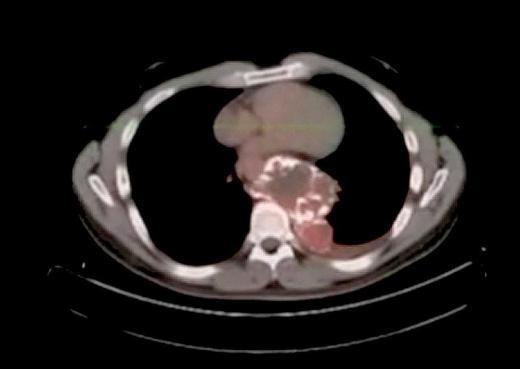 Kaliforniya'da yaayan Josh Abken, uzun sredir srt arlarndan ikayet ediyordu ve sonunda bir doktora gitti. Rntgen ekilmesi sonucu Abken'n srtnda futbol topu byklnde bir tmrn kaya gibi sertletii ve hatta zerine tyler bile kt tespit edildi.