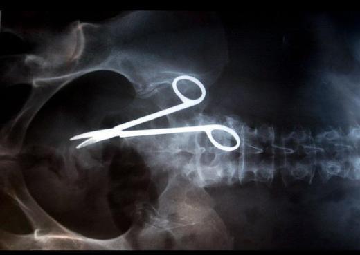 Avustralya'da ameliyat geiren bir erkein karnnda, tam 18 ay sonra ameliyat makas unutulduu tespit edildi.