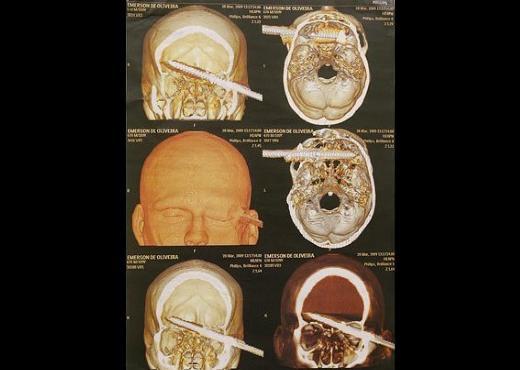 Bu CT scan grnts ise Brezilyal Emerson de Oliveira Abreu'ye ait. Sualtnda balk tutmaya alrken kaza sonucu kafasna zpkn saplanan Abreu, doktorlarn baarl operasyonu sonucu kurtarld.